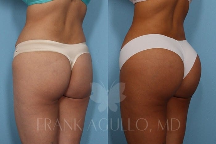 Butt Implants Before and After 3