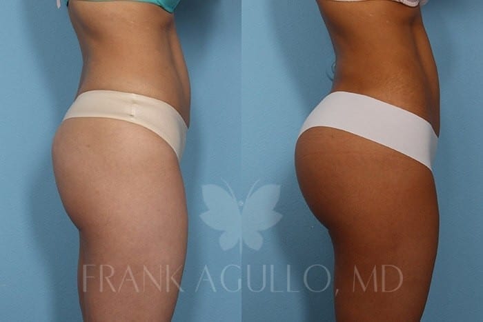 Butt Implants Before and After 2