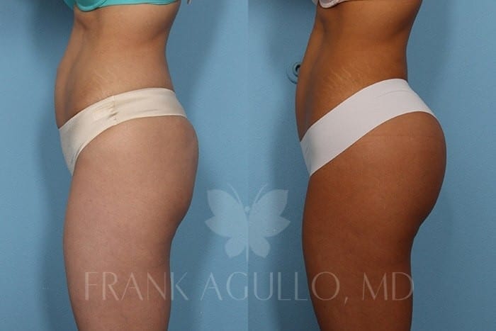 Butt Implants Before and After 3