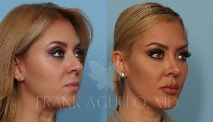 Rhinoplasty Before and After 4