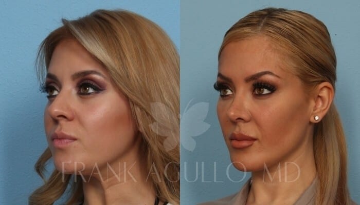 Rhinoplasty Before and After 3