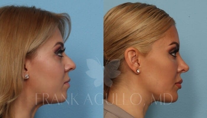 Rhinoplasty Before and After 2