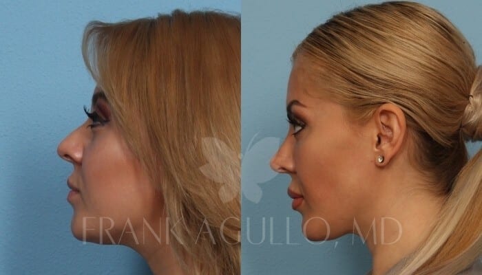 Chin Implant Before and After 4