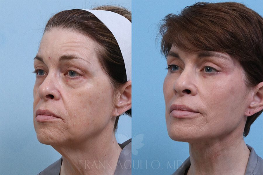 Face Lift Before and After 2