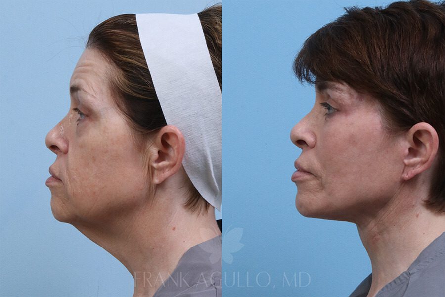 Face Lift Before and After 3