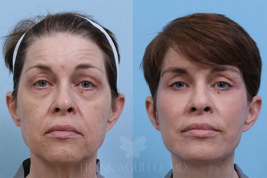 Face Lift Before and After 1