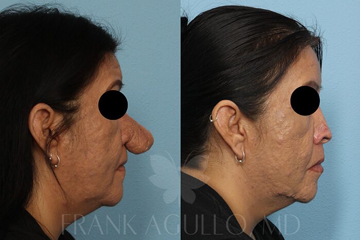 Rhinoplasty Before and After 3