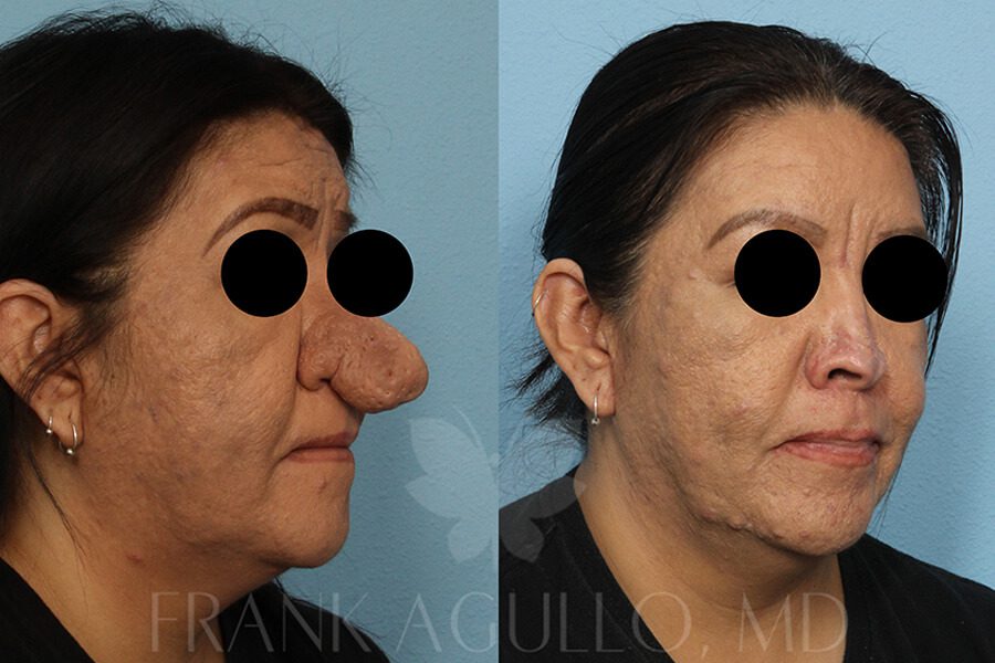 Rhinoplasty Before and After 1