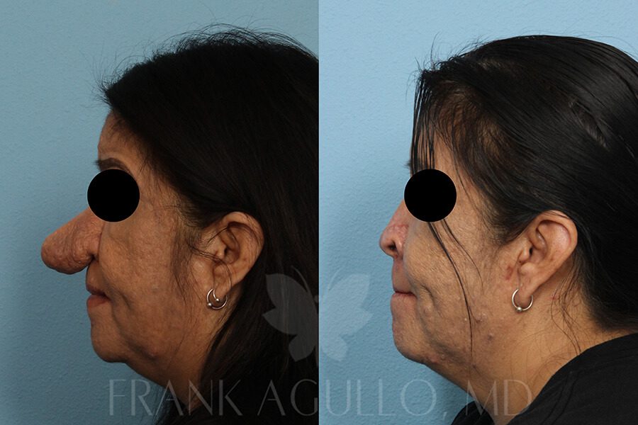 Rhinoplasty Before and After 2