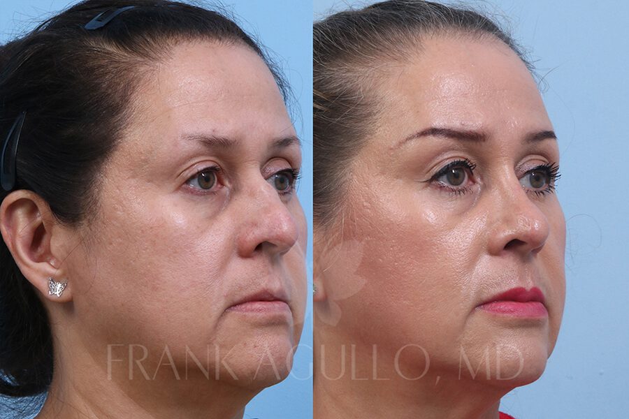 Rhinoplasty Before and After 10