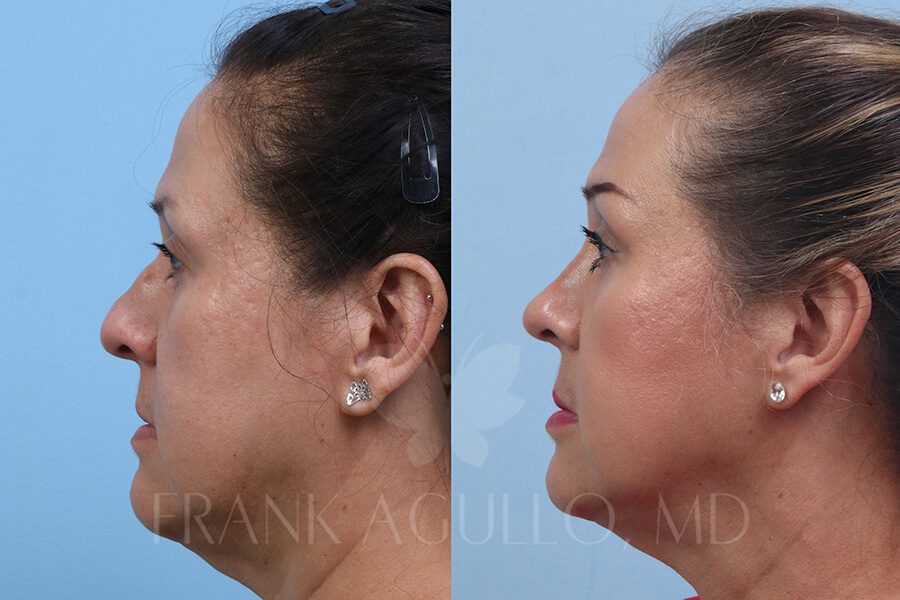 Rhinoplasty Before and After 2