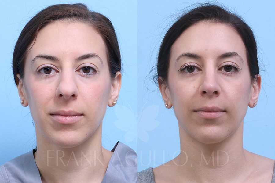 Rhinoplasty Before and After 11