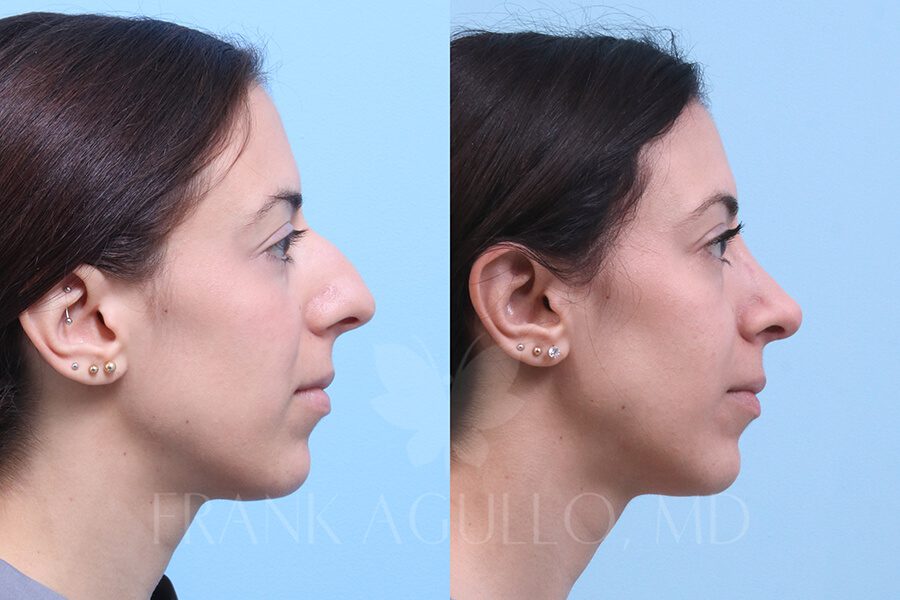 Rhinoplasty Before and After 2