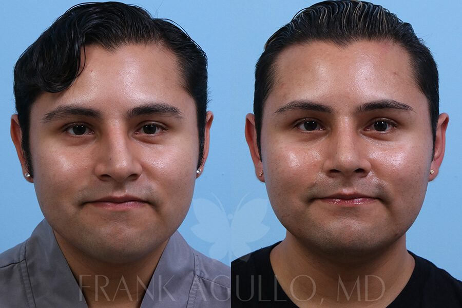 Rhinoplasty Before and After 12