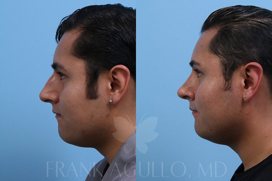 Rhinoplasty Before and After 2