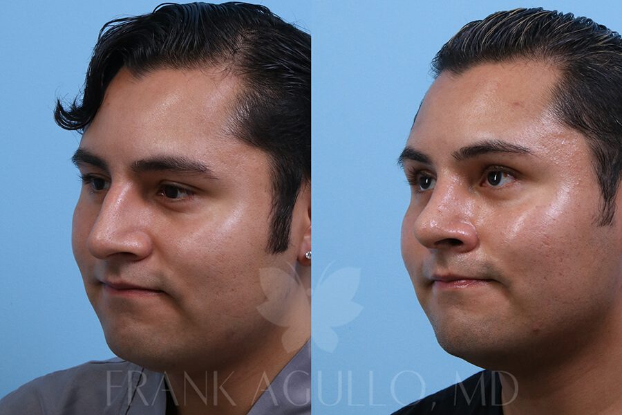 Rhinoplasty Before and After 3