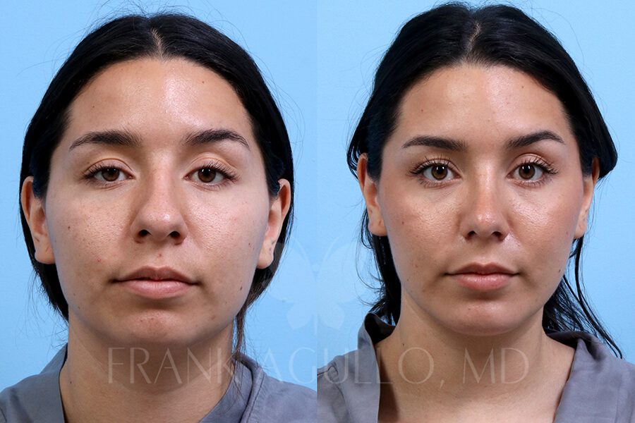 Rhinoplasty Before and After 13