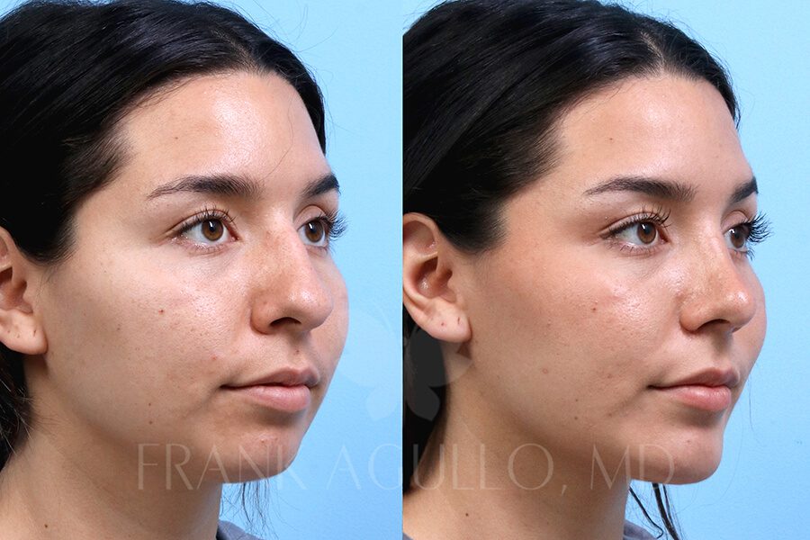 Rhinoplasty Before and After 2