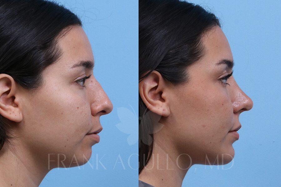 Rhinoplasty Before and After 3