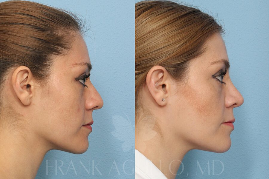 Rhinoplasty Before and After 2