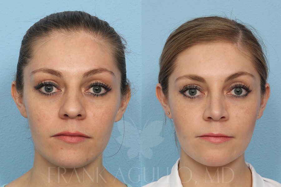 Rhinoplasty Before and After 14