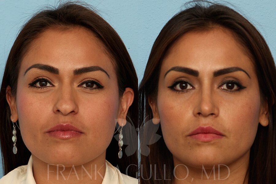 Rhinoplasty Before and After 15
