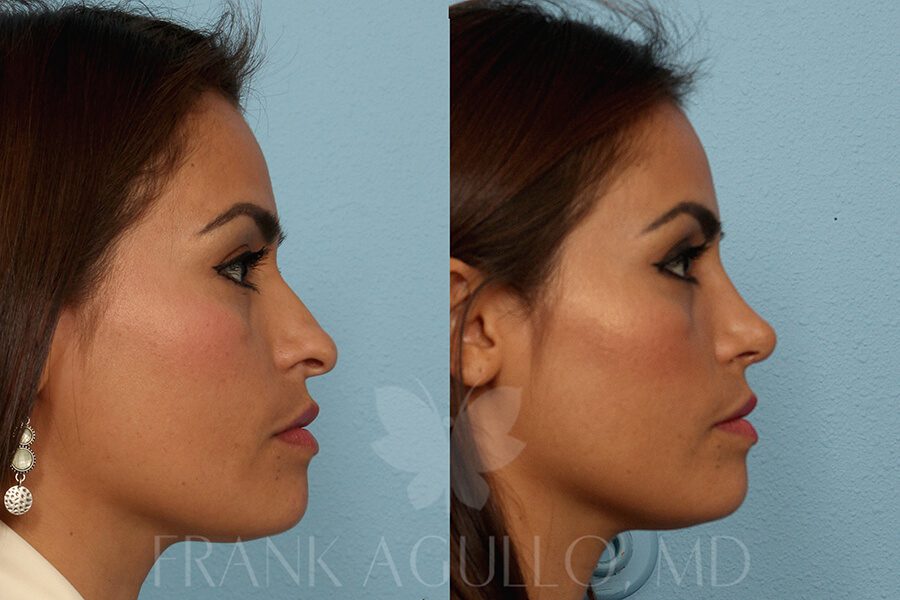 Rhinoplasty Before and After 2