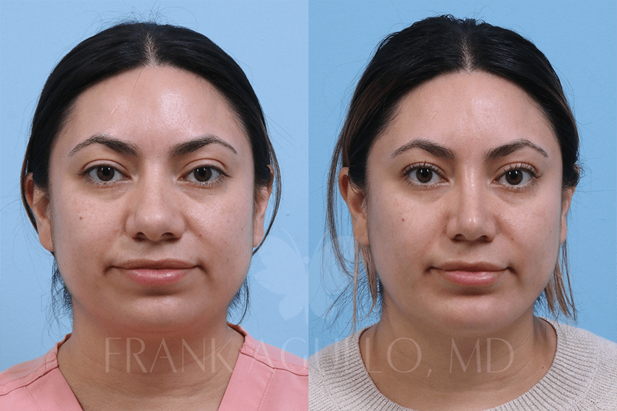 Rhinoplasty Before and After 16