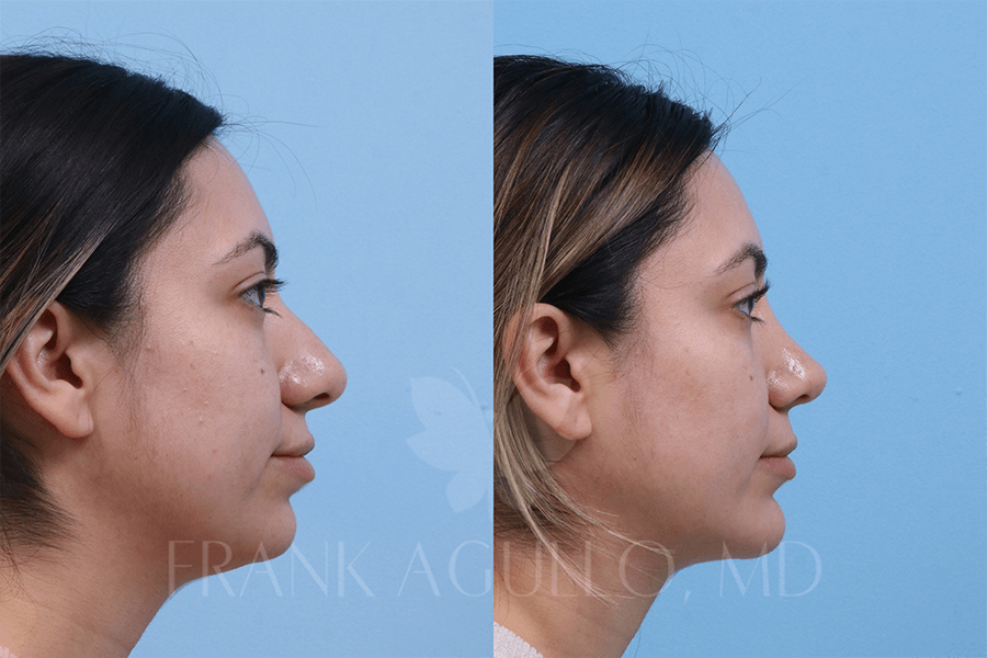Rhinoplasty Before and After 2