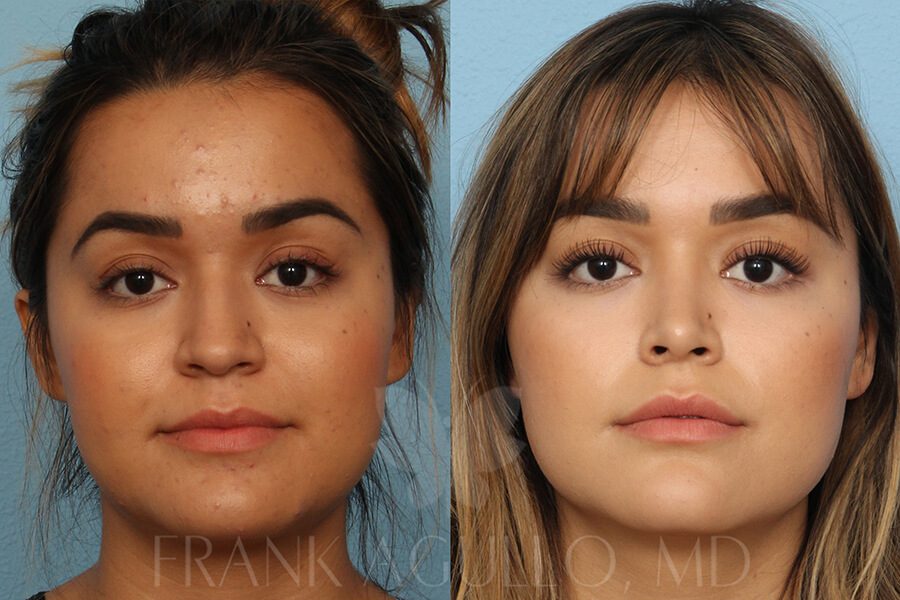 Rhinoplasty Before and After 17