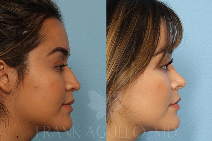Rhinoplasty Before and After 2