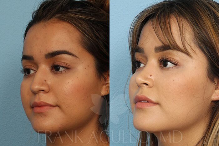 Rhinoplasty Before and After 3
