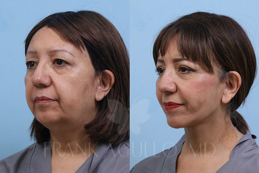 Face Lift Before and After 2