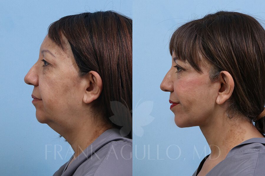 Face Lift Before and After 3