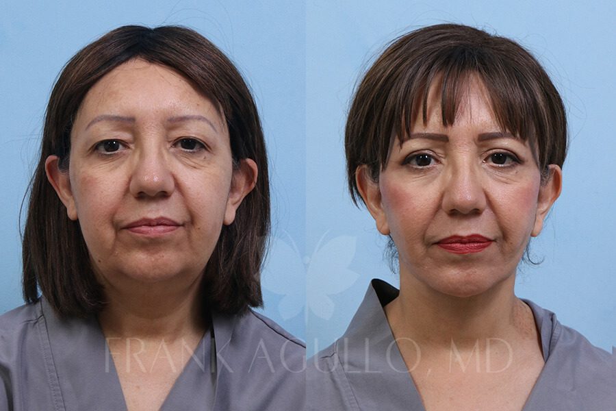 Face Lift Before and After 2