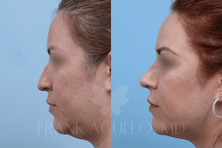 Rhinoplasty Before and After 2