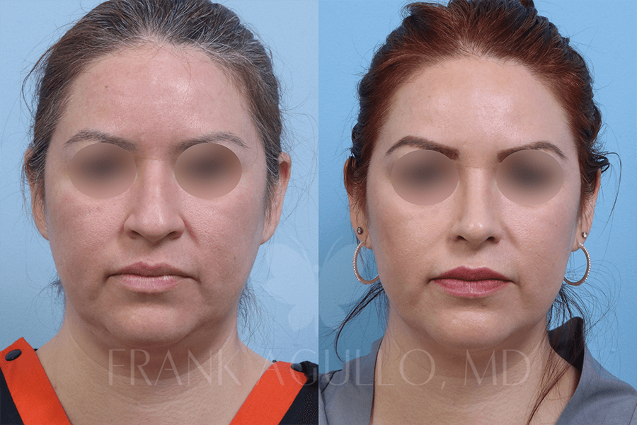 Rhinoplasty Before and After 2