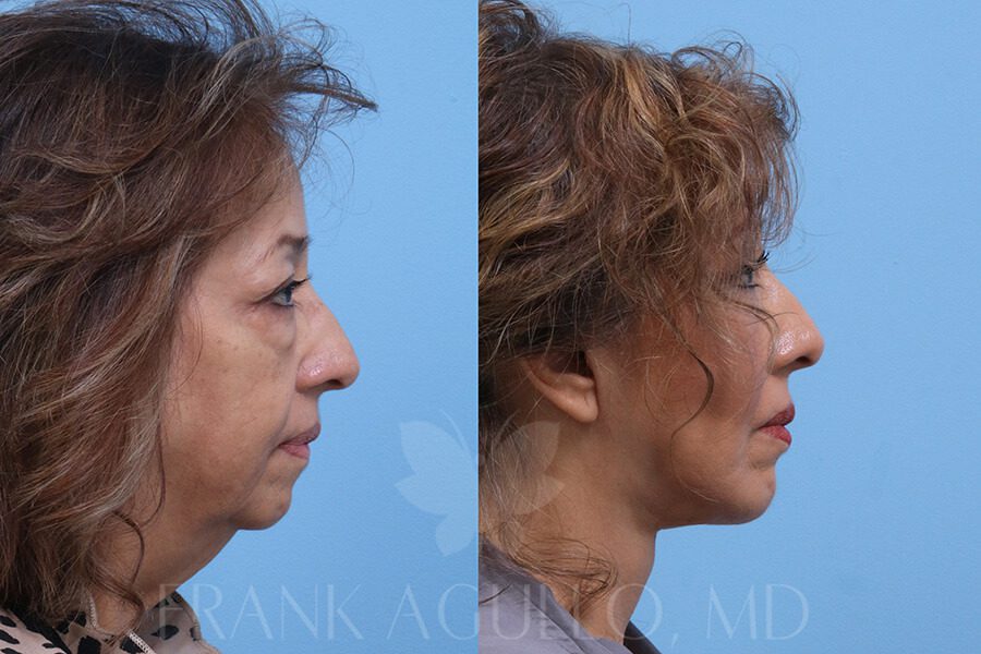 Face Lift Before and After 3
