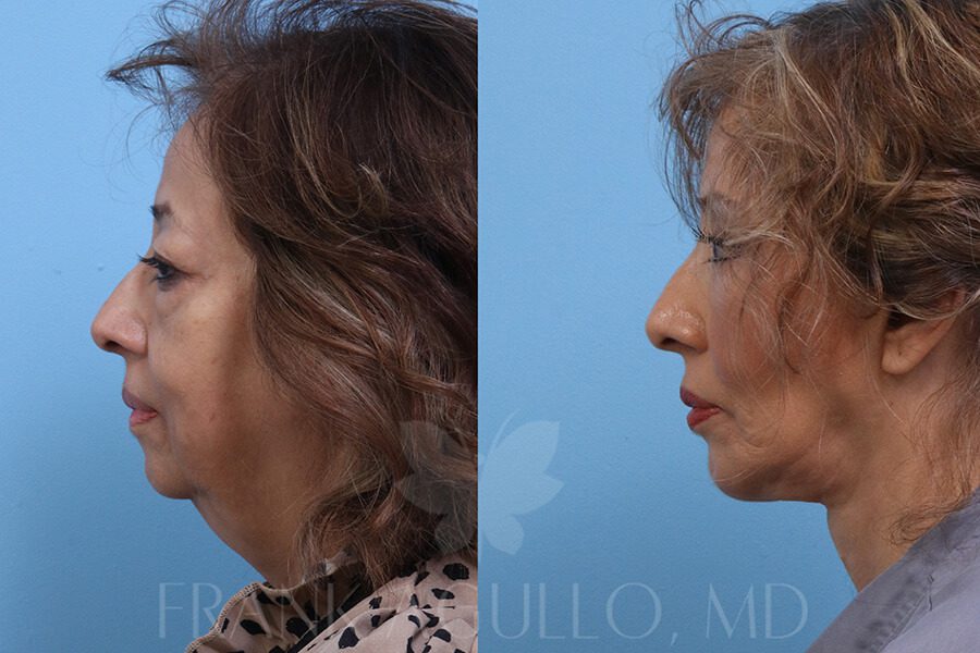 Face Lift Before and After 5