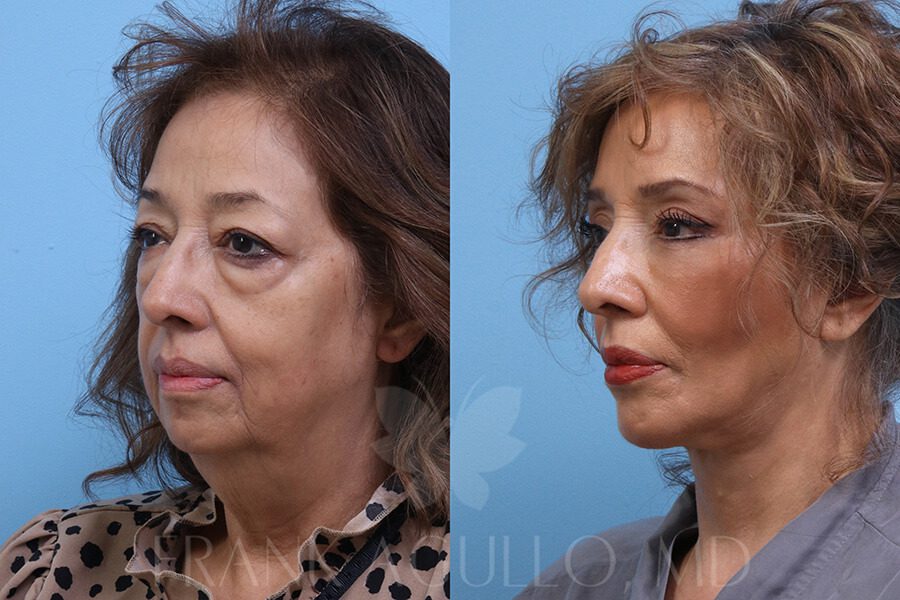 Face Lift Before and After 4