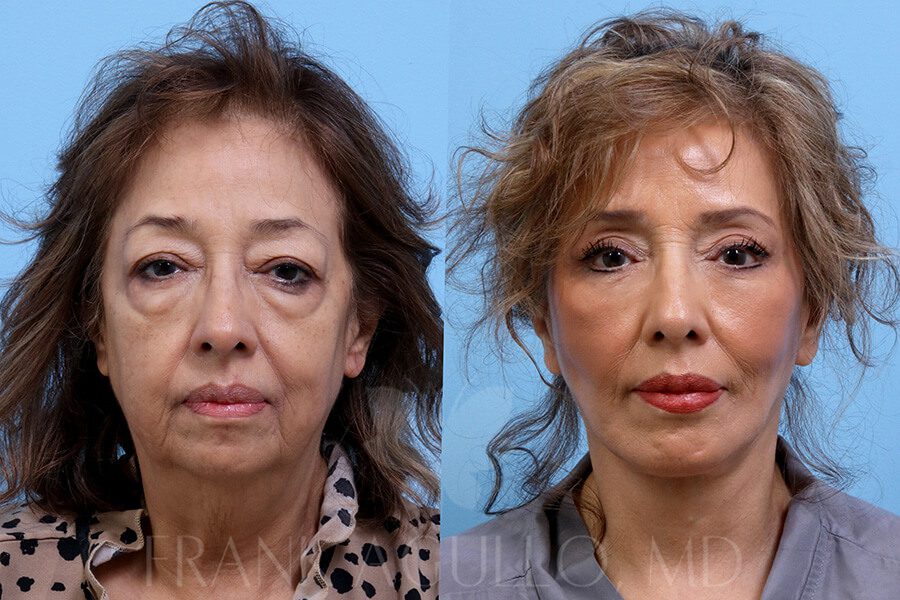 Face Lift Before and After 3
