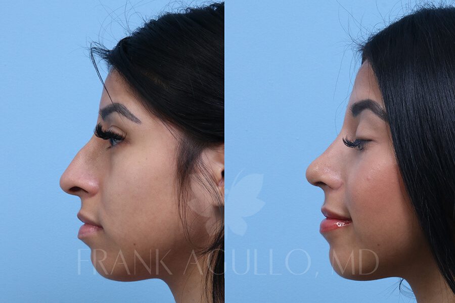 Rhinoplasty Before and After 2