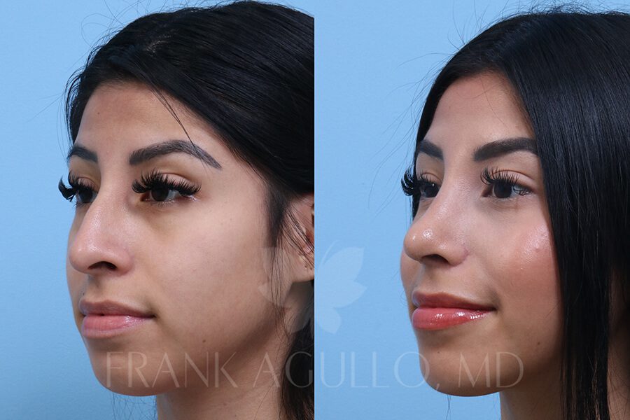 Rhinoplasty Before and After 3