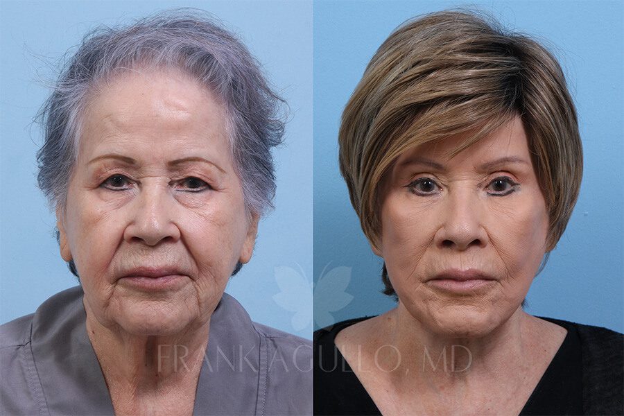 Face Lift Before and After 4