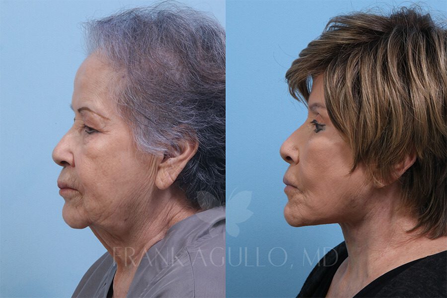 Face Lift Before and After 2