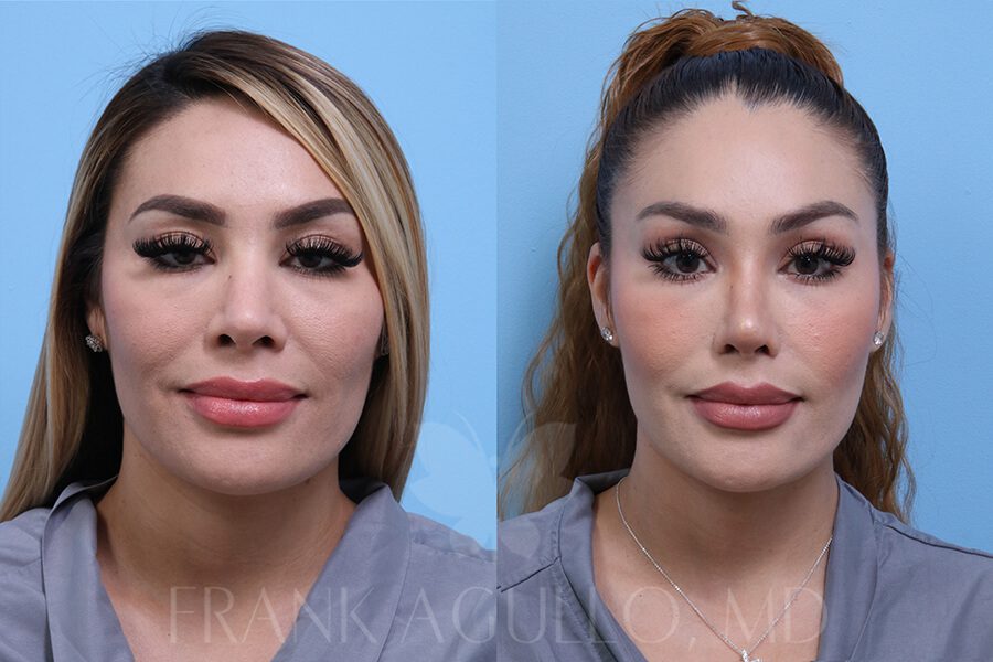 Rhinoplasty Before and After 4