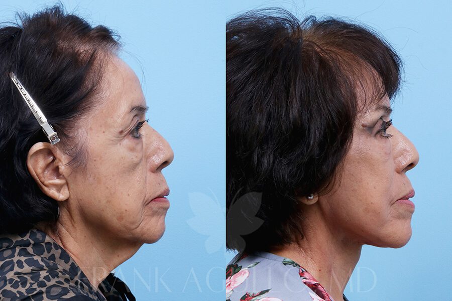 Face Lift Before and After 3
