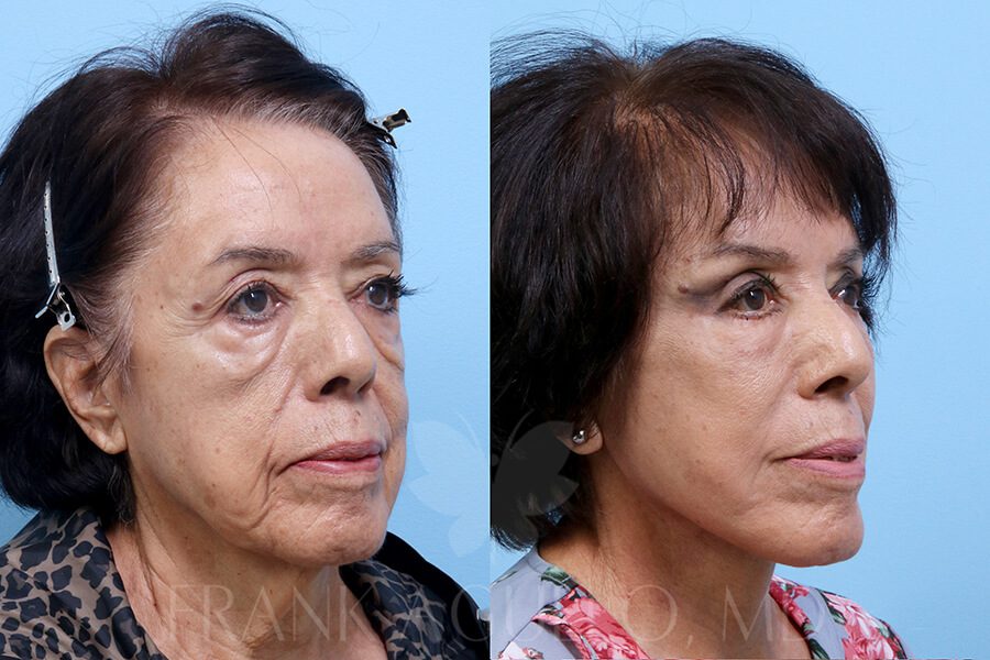 Face Lift Before and After 2