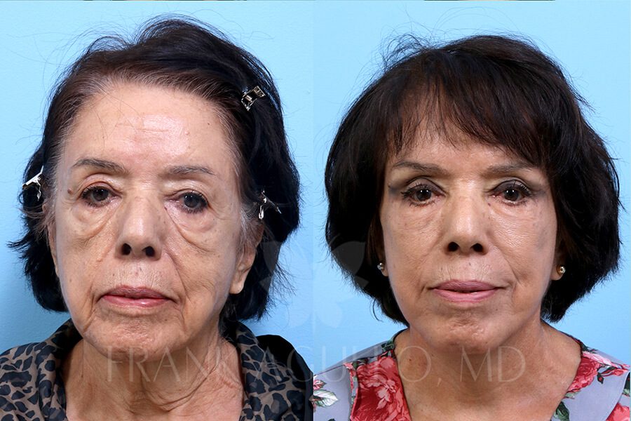 Face Lift Before and After 5