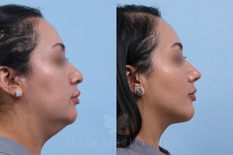 Rhinoplasty Before and After 3